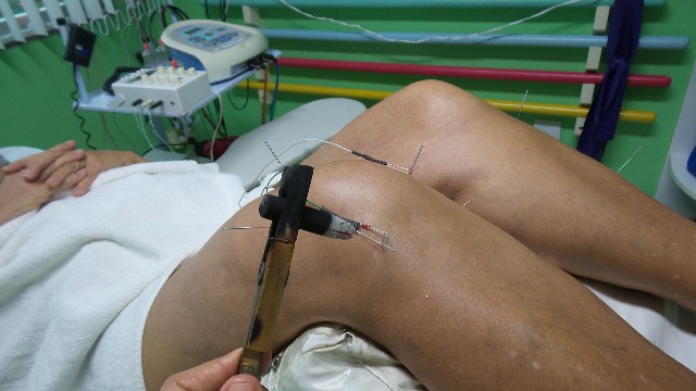 artrose-de-joelho-acupuntura